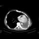 Pneumonectomy: CT - Computed tomography